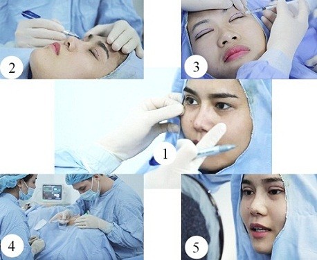Quy trình cắt mí mắt Plasma tại Kangnam