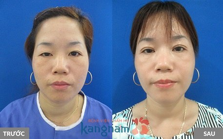 Trẻ ra vài tuổi nhờ cắt mí mắt Plasma tại Kangnam
