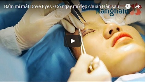 Bấm mí mắt là cách phòng ngừa lẹo mắt hiệu quả cao