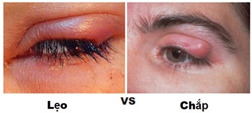 Sự khác nhau giữa lẹo mắt và chắp mắt