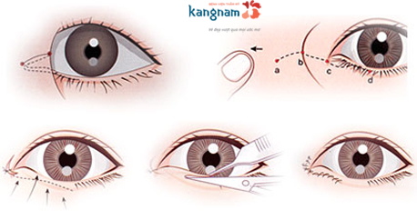 phẫu thuật thẩm mỹ mắt to mắt nhỏ 5