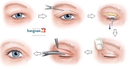 phẫu thuật thẩm mỹ mắt to mắt nhỏ 4
