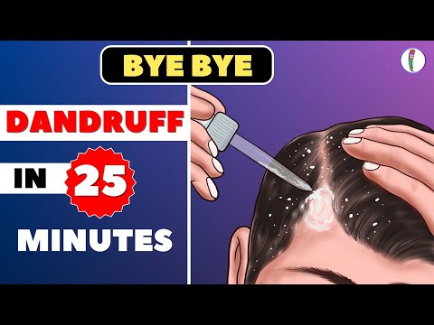 🔥#1 Dandruff Treatment at Home | How to get rid of Dandruff | Dandruff Removal | Itchy scalp