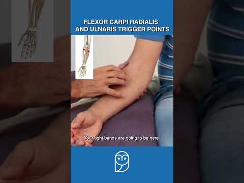 Is Your Wrist Pain Caused By Trigger Points In the Forearm Flexors?